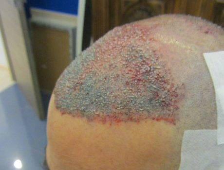 Trapianto Capelli FUE – 49 Anni – 3180 Innesti – 1 sessione