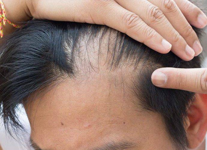 Alopecia da stress: cos’è, cause e come si cura