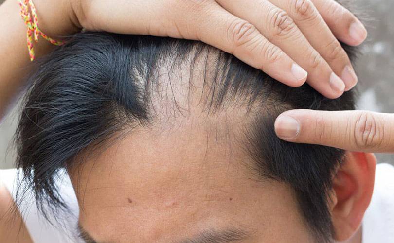 Alopecia da stress: cos’è, cause e come si cura
