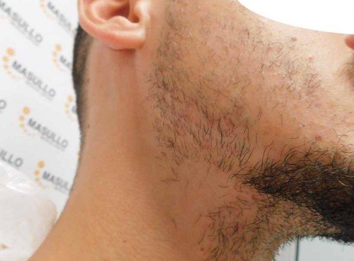 Alopecia della Barba. Cause, sintomi e rimedi.