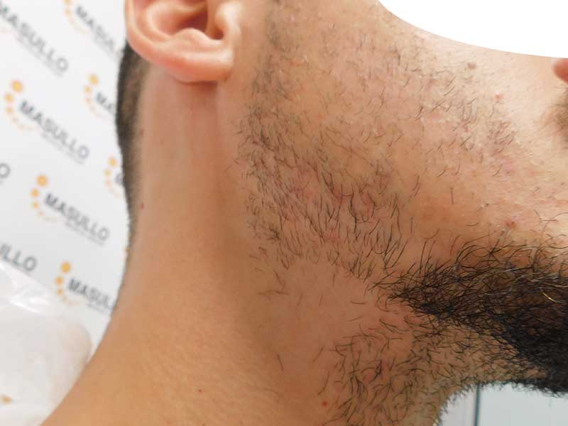 Alopecia della Barba. Cause, sintomi e rimedi.