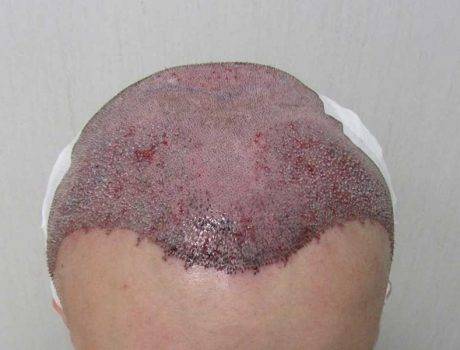 Trapianto Capelli FUE – 25 anni – 3300 Innesti – 1 Sessione