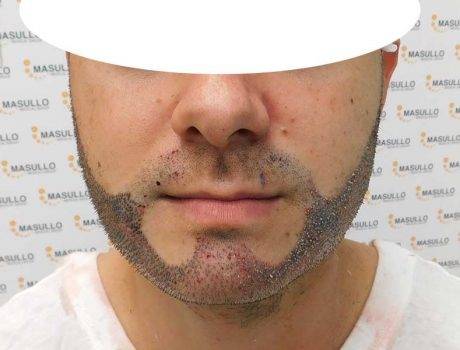 Trapianto Barba – 29 anni – 3000 Innesti – 1 sessione