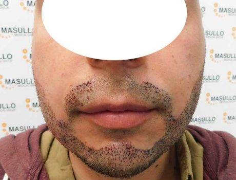 Trapianto Barba – 30 Anni – 2500 Innesti – 1 Sessione