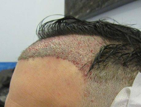 Trapianto Capelli FUE – 33 Anni – 2000 Innesti – 1 Sessione