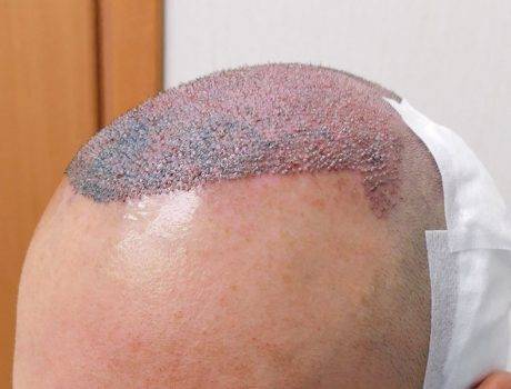 Trapianto Capelli FUE – 30 Anni – 3600 Innesti – 1 sessione