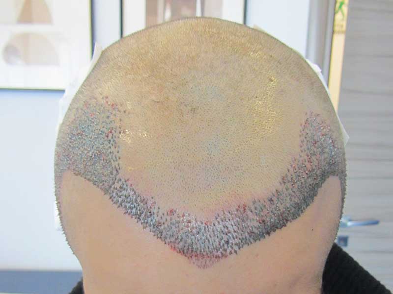 Trapianto Capelli FUE – 28 Anni – 1940 Innesti – 1 Sessione