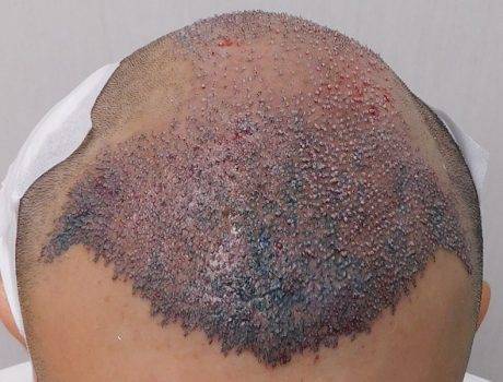 Trapianto Capelli FUE – 29 Anni – 3040 Innesti – 1 Sessione