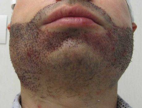 Trapianto Barba – 35 anni – 2800 Innesti – 1 sessione