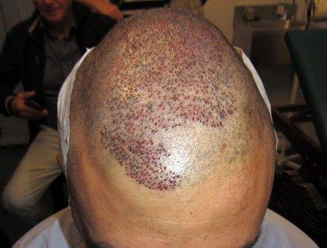 Trapianto Capelli FUE – 38 Anni – 2300 Innesti – 1 Sessione