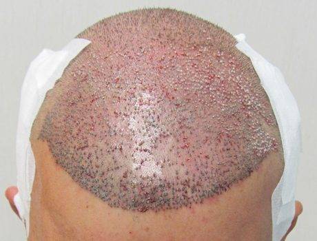 Trapianto Capelli FUE – 45 Anni – 4500 Innesti – 2 Sessioni