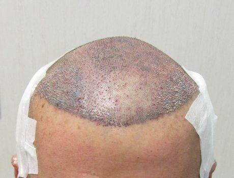 Trapianto Capelli FUE – 54 Anni – 4275 Innesti – 2 Sessioni