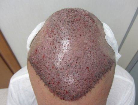 Trapianto Capelli FUE – 37 Anni – 3500 Innesti – 1 Sessione