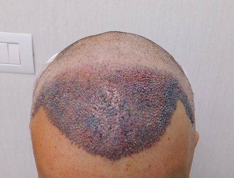 Trapianto Capelli FUE – 39 Anni – 2500 Innesti – 1 sessione