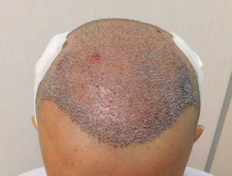 Trapianto Capelli FUE – 31 Anni – 3200 Innesti – 1 Sessione