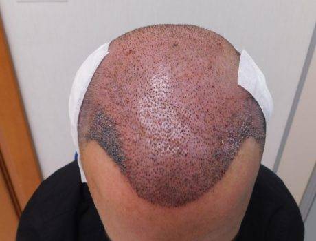 Trapianto Capelli FUE – 34 Anni – 3030 Innesti – 1 Sessione