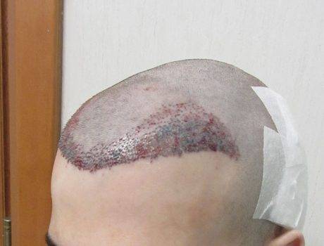 Trapianto Capelli FUE – 21 Anni – 2000 Innesti – 1 Seduta