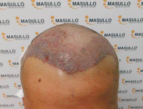 Trapianto Capelli Fue – 30 Anni – 2050 Innesti – 1 Sessione