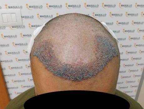 Trapianto Capelli FUE – 28 Anni – 2960 Innesti – 1 Sessione