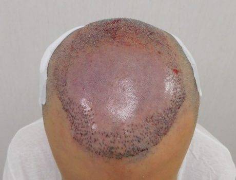 Trapianto Capelli FUE – 36 Anni – 2260 innesti – 1 Sessione