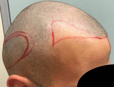 Trapianto Capelli FUE – 24 Anni – 1500 Innesti – 1 Sessione