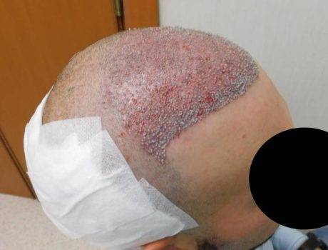 Trapianto Capelli FUE – 25 Anni – 2500 Innesti – 1 Sessione