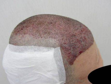 Trapianto Capelli Fue – 41 Anni – 4800 Innesti – 2 Sessioni