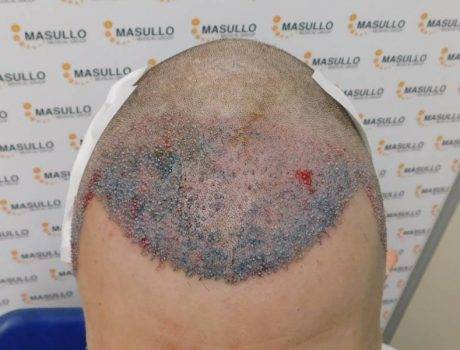 Trapianto Capelli Fue – 33 Anni – 2400 Innesti – 1 Sessione