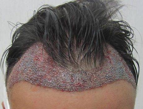 Trapianto Capelli Fue – 37 Anni – 2000 Innesti – 1 Sessione