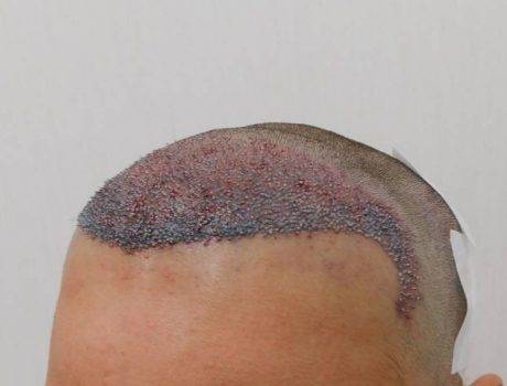 Trapianto Capelli Fue – 41 Anni – 2500 Innesti – 1 Sessione