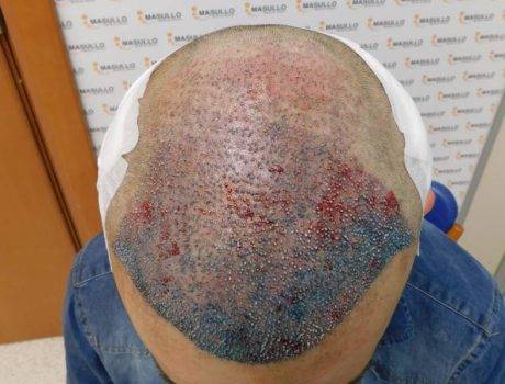 Trapianto Capelli Fue – 38 Anni – 3000 Innesti – 1 Sessione