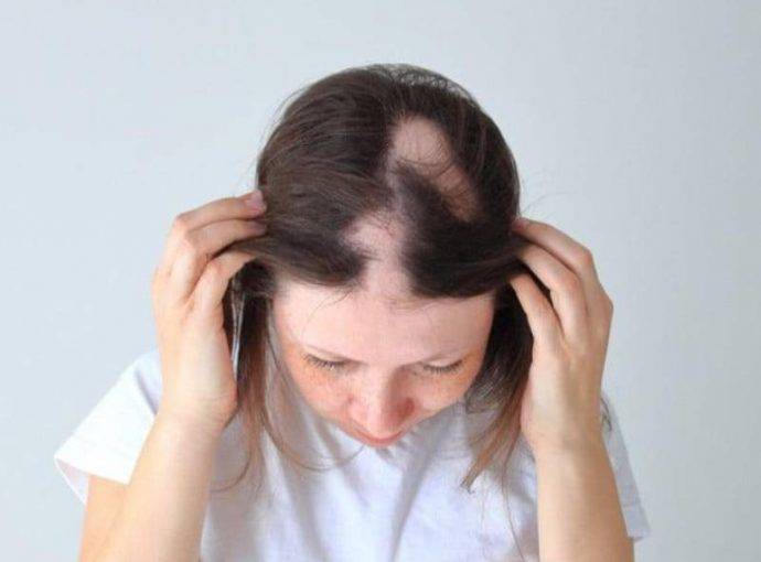 Alopecia da carenze alimentari: cos’è, cause e rimedi