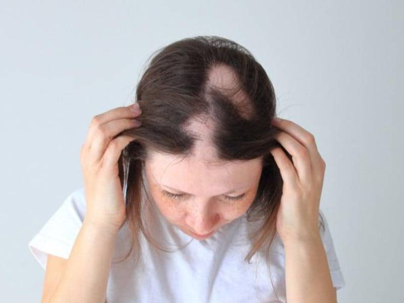 Alopecia da carenze alimentari: cos’è, cause e rimedi