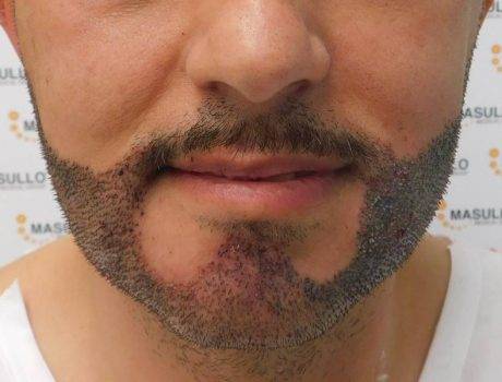 Trapianto Barba – 42 anni – 3550 Innesti – 2 sessioni