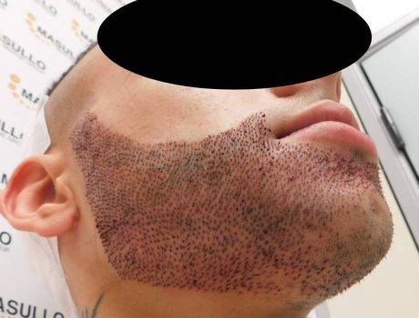 Trapianto Barba – 21 anni – 4000 Innesti – 2 sessioni