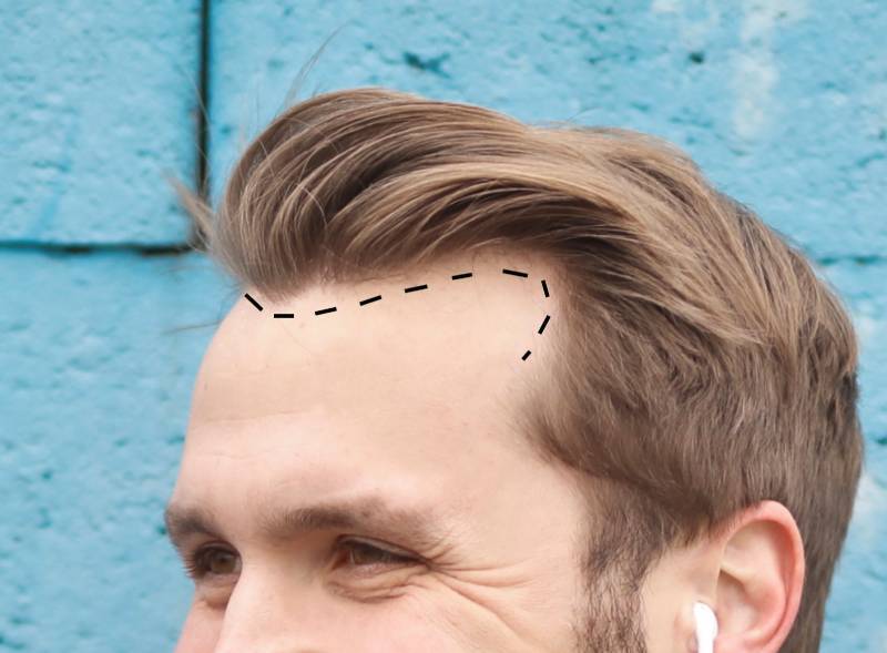 Classificazione ed Arretramento dell’Hairline (Uomo-Donna)