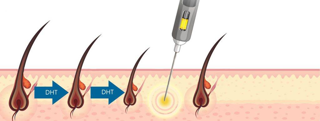 Trattamento Mesoterapico