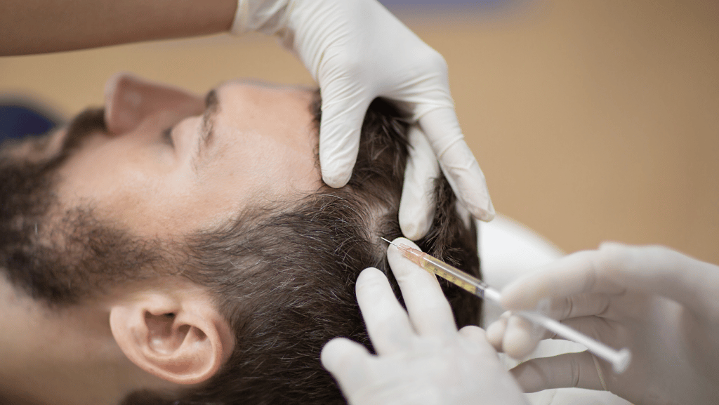 Mesoterapia Tricologica: un supporto per il benessere di capelli e cuoio capelluto