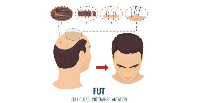 Trapianto Capelli con Tecnica FUT (Strip Extraction)