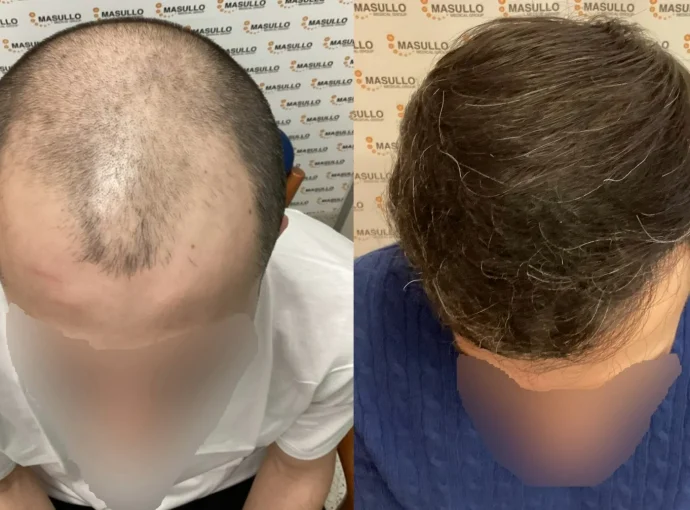 Il Trapianto di Capelli Funziona? La Risposta Definitiva