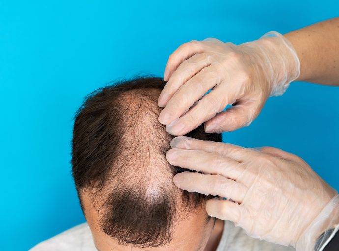 Trapianto Capelli Andato Male: Perché Succede, Come Evitarlo e Come Correggerlo