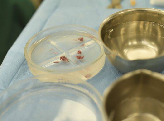 Rischi del trapianto di capelli e come prevenirli