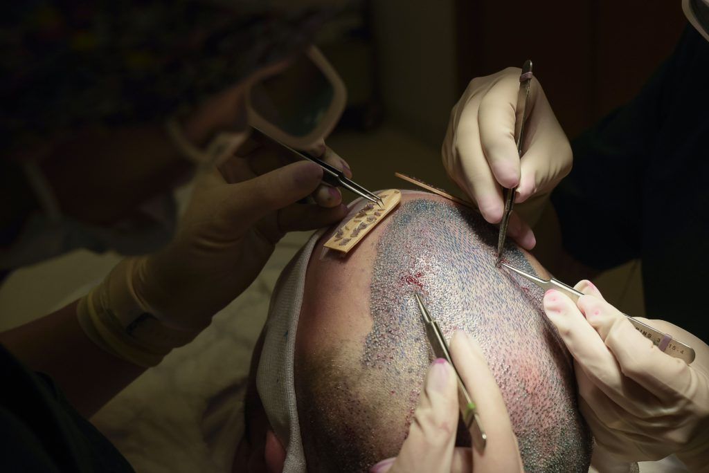 Trapianto di capelli